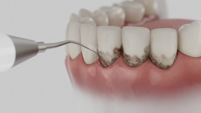 Trusted Wisdom Tooth Removal service in Damascus, OR - Dentist Open Now